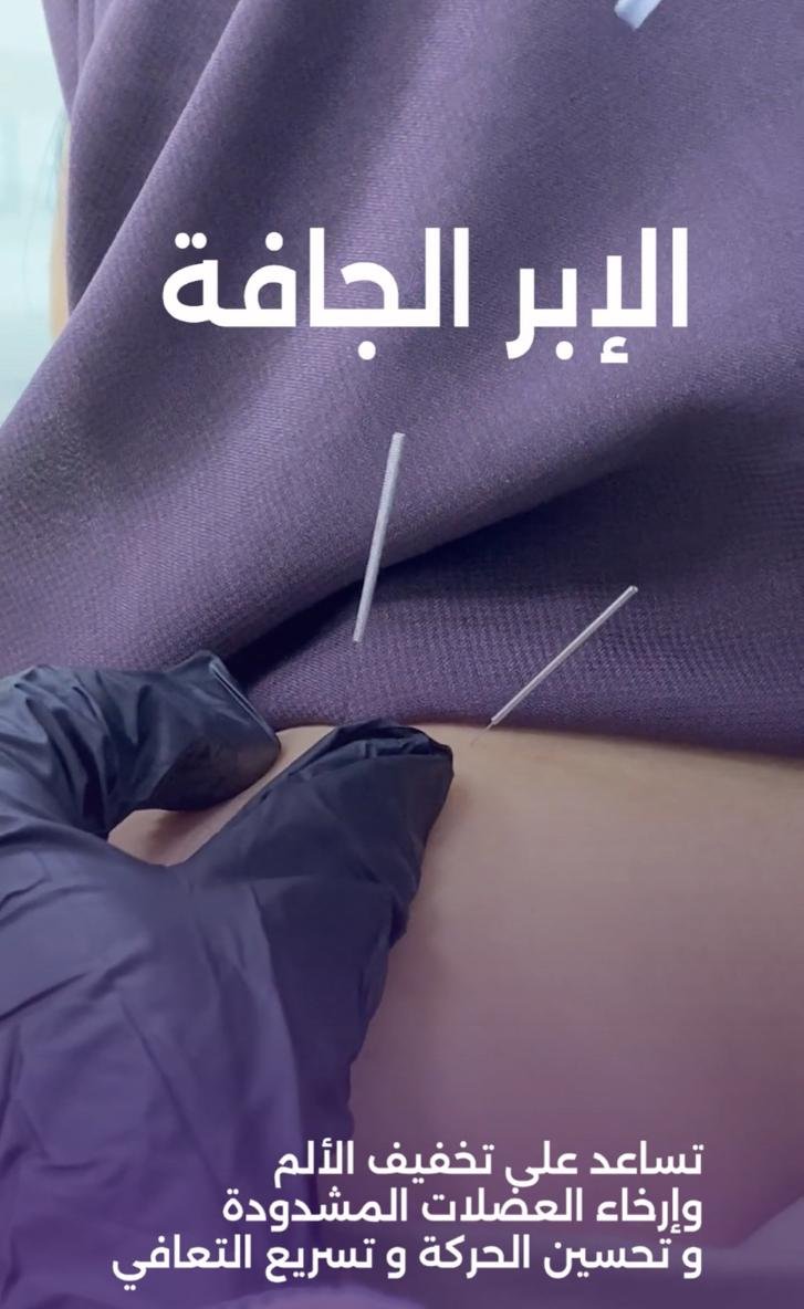 الإبر الجافة في مركز السمو للتأهيل والعلاج الطبيعي