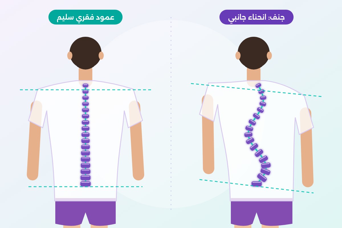 رسم توضيحي لانحناء جانبي في العمود الفقري لدى طفل (الجنف)