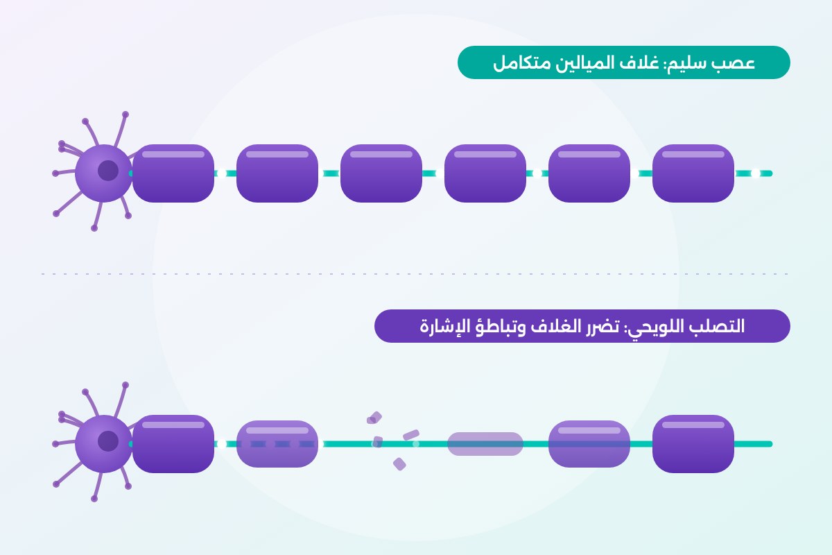 رسم توضيحي لعصب سليم مقابل عصب تضرر غلاف الميالين في التصلب اللويحي